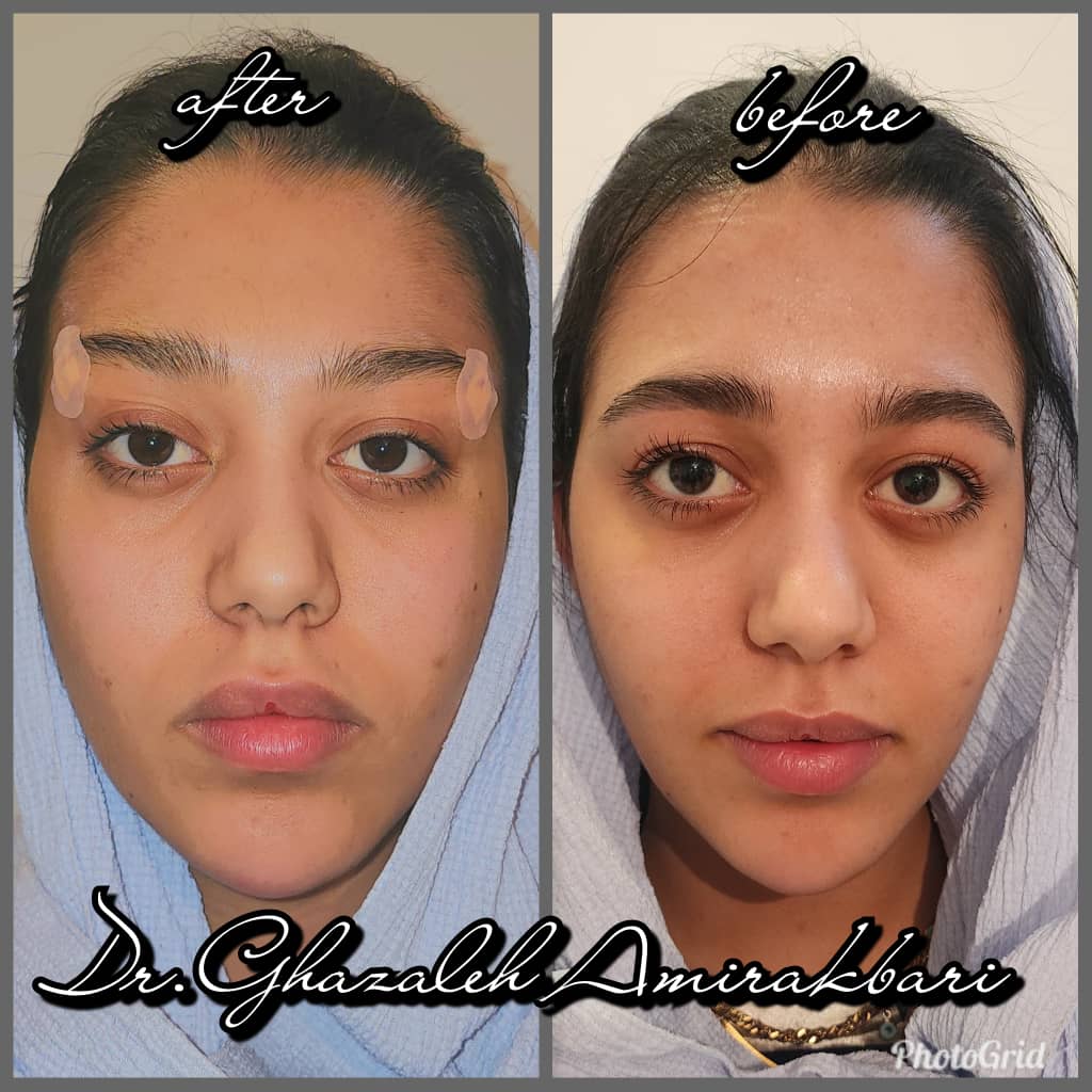 لیفت چشم و ابرو با نخ