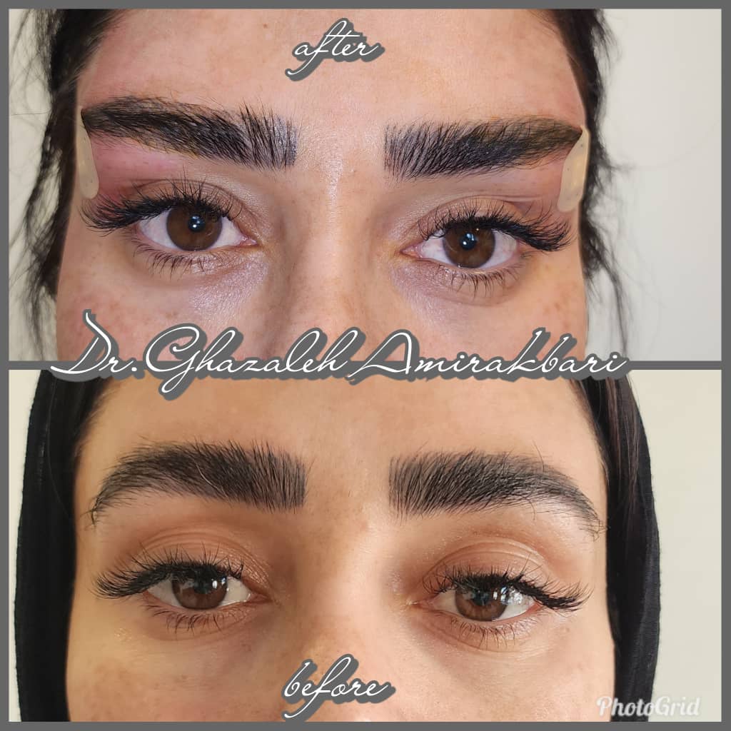 "لیفت چشم و ابرو با نخ"